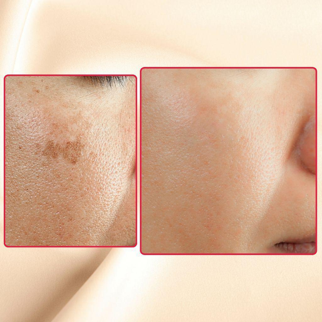 The Eraser Spot Cream | Dark Spot Corrector