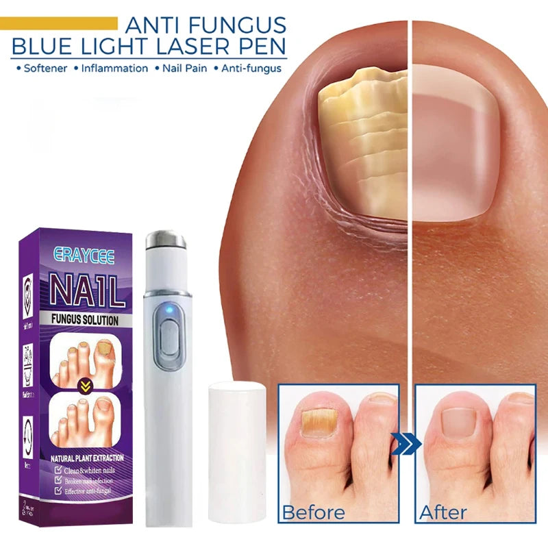 Medical-Grade Nail Fungus Laser Pen – Portable Device for Toenail Restoration & Fungal Infection Repair