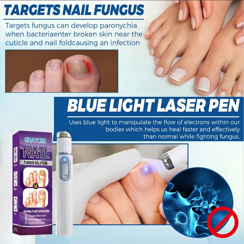 Medical-Grade Nail Fungus Laser Pen – Portable Device for Toenail Restoration & Fungal Infection Repair