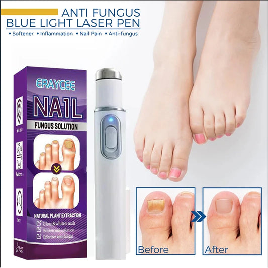 Medical-Grade Nail Fungus Laser Pen – Portable Device for Toenail Restoration & Fungal Infection Repair